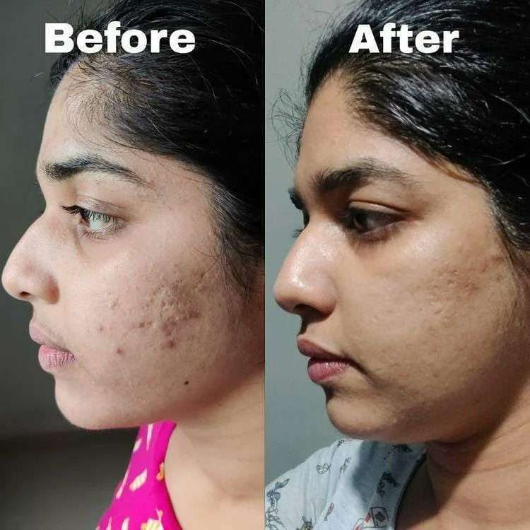 Alfis Products Before And After Results